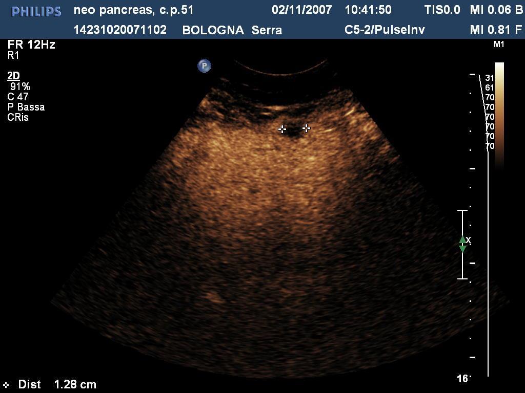 CEUS: DETECTION METASTASI EPATICHE L