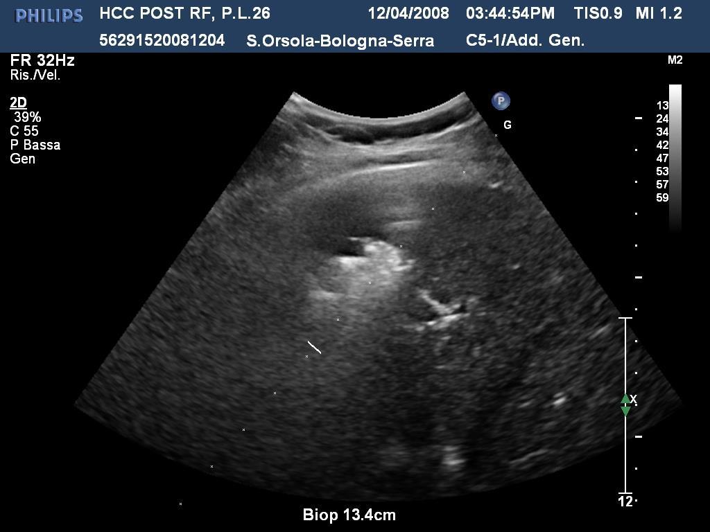 tessuto neoplastico residuo