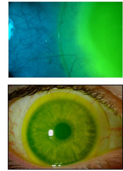 SOLLEVAMENTO LIMBARE CL CLEARANCE LIMBARE OTTIMALE: La fluoresceina copre tutta la cornea periferica, il limbus e la sclera.