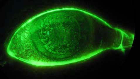 COMPLICANZE CORNEALI: STAINING DIFFUSO N.B.