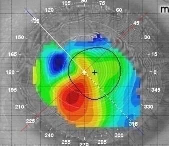 TRAPIANTI DI CORNEA