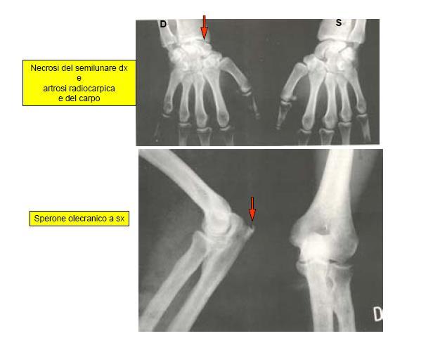 SINDROME DA VIBRAZIONI MANO BRACCIO lesioni muscoloscheletriche Lesioni tendinee: tendinite dei muscoli flessori della mano Lesioni