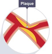 Le occlusioni tromboemboliche acute e sub-acute sono tuttora una delle principali cause di ischemia periferica e di amputazione degli arti.