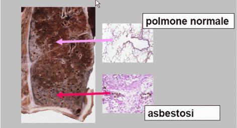 ASBESTOSI Il potere patogeno è da riferire alla capacità delle sottilissime fibre rettilinee di anfiboli di penetrare in profondità nell apparato respiratorio, ed in particolare le fibre con diametro