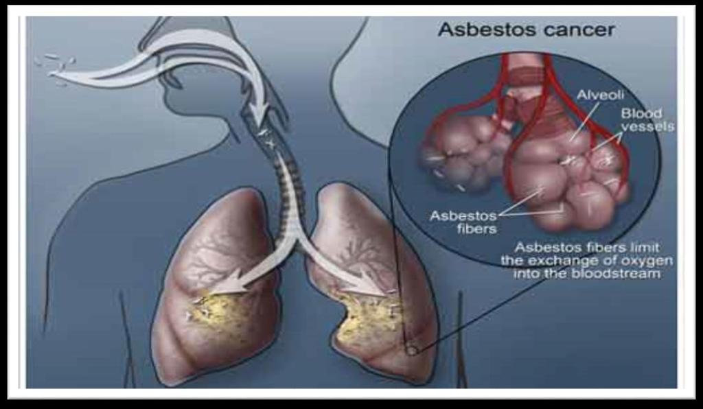 CARCINOMA POLMONARE Per questa patologia sono chiamati in causa tutti i tipi di amianto ed è importante l intensità di esposizione.