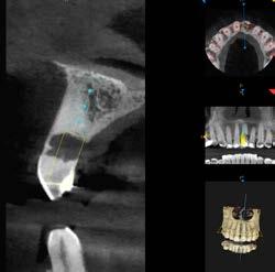 congenita degli incisivi laterali. L ortodontista aveva aperto il dente n. 12 in misura sufficiente per un impianto.