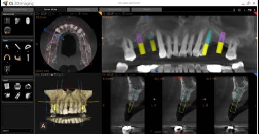 Immagine preoperatoria (5 cm x 5 cm) che mostra il sito di impianto e la posizione del canale mandibolare.