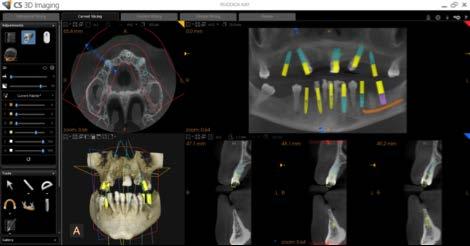 L esame preoperatorio (8 cm x 5 cm) mostra chiaramente il volume di osso disponibile e la posizione del canale mandibolare.