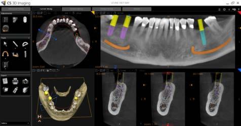 tutti i propri problemi odontoiatrici. Il FOV 8 cm x 9 cm acquisito con il CS 8100 3D consentì la valutazione dell intera bocca e la visualizzazione di varie possibilità di impianti.