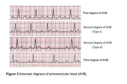 ECG: new