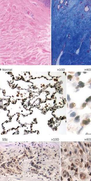 LA FIBROSI La fibrosi o sclerosi è una condizione caratterizzata dall aumento di tessuto connettivale stromale, in particolare di collagene di tipo I, all interno di organi parenchimatosi.