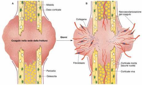 Nelle fasi iniziali della guarigione di una ferita ossea, si ha un coagulo ematico che consegue alla rottura dei capillari dell osteoide.