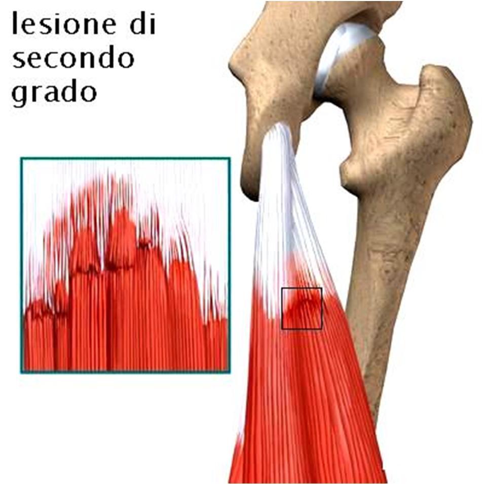 Lesione muscolare Dolore e impotenza funzionale anche