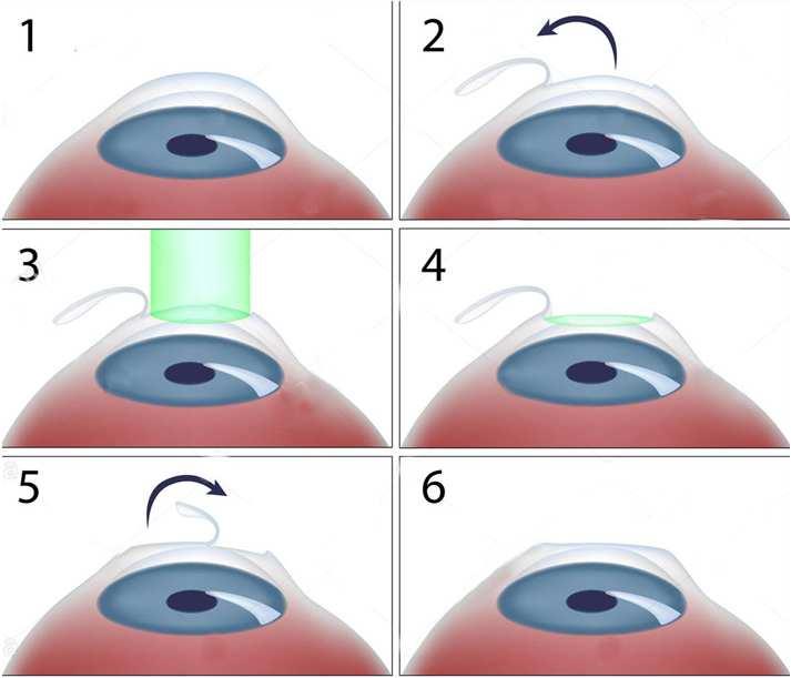 eccimeri (FEMTO LASIK)