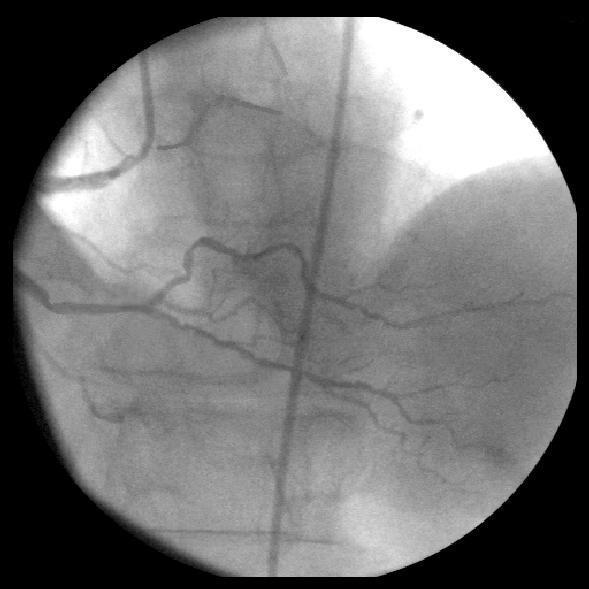 La stenosi valvolare aortica Stenosi valvolare aortica degenerativa Può