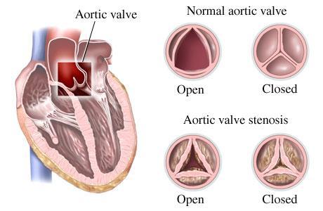 La stenosi valvolare aortica Anatomia della valvola aortica Nella forma piu semplice la valvola aortica è costituita da tre lembi che