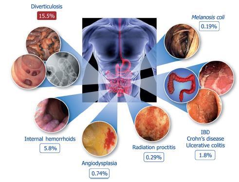 Epidemiologia La diverticolosi colica è la più frequente alterazione anatomica evidenziata in