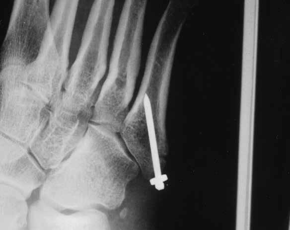 GUIDA RAPIDA 8 PIEDE Nei metatarsi e nelle falangi prossimali usare dei fili filettati FFS grandi oppure medi. Fratture del metatarso e della falange In displaced fractures, use open reduction.