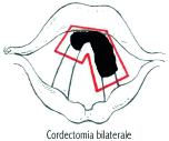 Carcinoma della corda