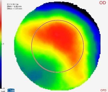 L USO DI LENTI A CONTATTO RIGIDE GAS-PERMEABILI