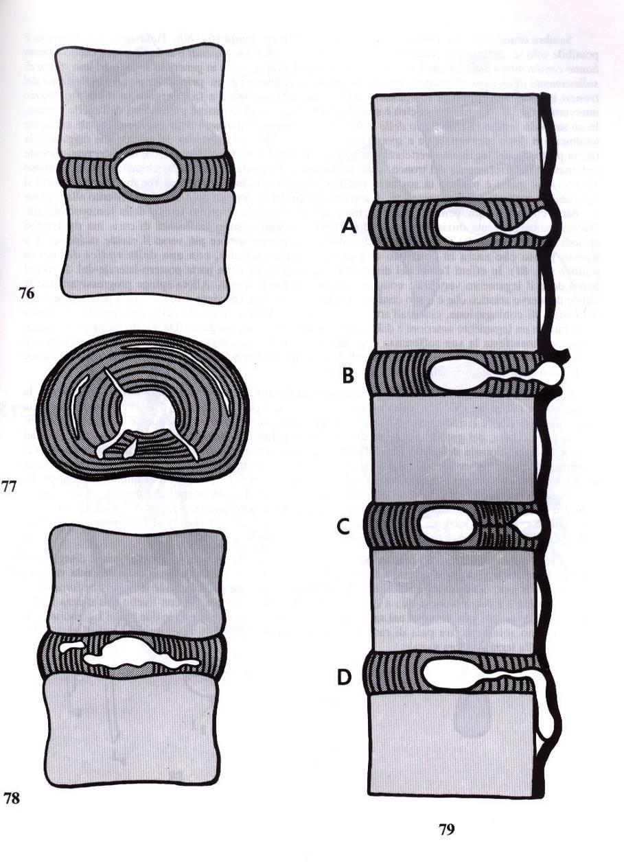 Tipi di ERNIA Discale 1 1) Ernia Intra-spongiosa ( quando le fibre dell anello fibroso resistono) 2) Degenerazione del disco (dopo i 25 anni di età) il nucleo si fa strada attraverso le fissurazioni