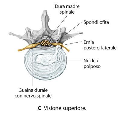 ERNIA PROTRUSA/ESPULSA La sintomatologia clinica varia in rapporto alla direzione ed al livello in cui si verifica