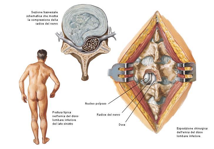 L ernia si localizza spesso POSTERO-LATERALMENTE: L anello fibroso è