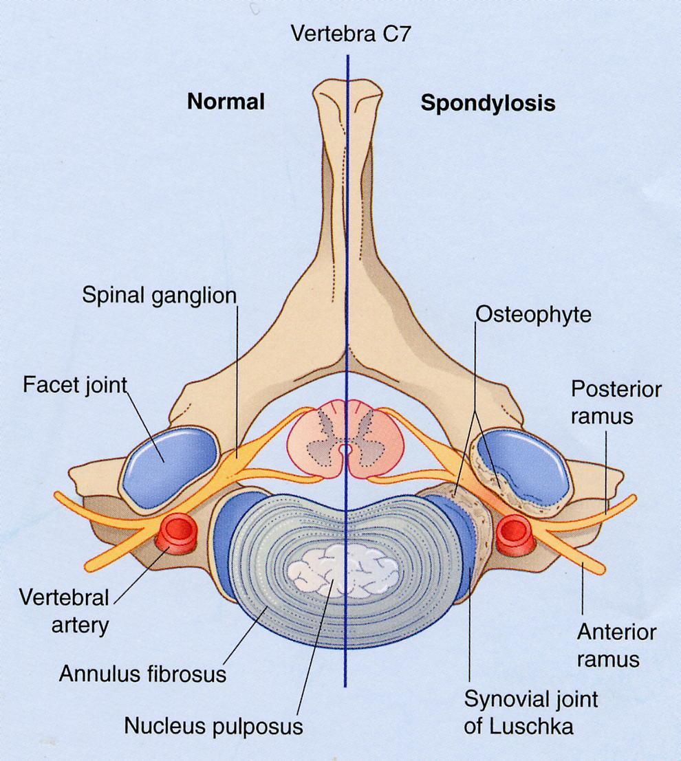 Processo artrosico a carico dei processi articolari delle vertebre stenosi del canale di