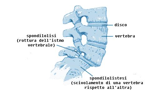 Spondilolistesi É quasi sempre associata a spondilolisi ( malformazione congenita o frattura delle parti interarticolari delle lamine -> ISTMO VERTEBRALE) Spondilolisi istmica: lisi a livello dell