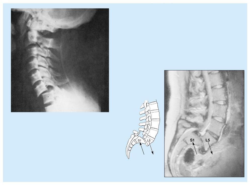 Spondilolistesi istmica: quando la lisi a livello dell istmo progredisce fino allo slittamento della vertebra divisa in una parte anteriore (corpo,