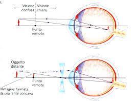 Un occhio miope ha punto prossimo 2 cm e remoto 7 cm Quale deve essere la potenza delle lenti per vedere gli oggetti lontani? Quale sarà la posizione del punto prossimo con gli occhiali?