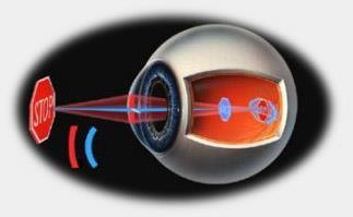 Astigmatismo Non uniforme curvatura del cristallino. La visione risulta confusa e distorta.