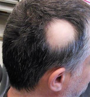 La sensazione di perdere tanti capelli è molto comune e di solito riguarda tante persone durante i cambi di stagione. In questi casi i capelli persi quasi sempre ricrescono in pochi mesi.