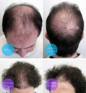 PAGINA 5 Alopecia androgenetica L alopecia androgenetica, più comunemente nota come calvizie, rappresenta la forma più comune di perdita di capelli.