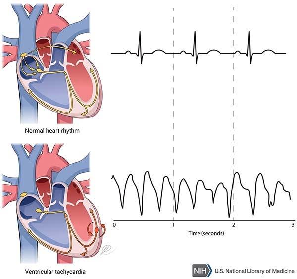 Cannabis : Effetti sull apparato cardiovascolare Includono principalmente tachicardia e lieve