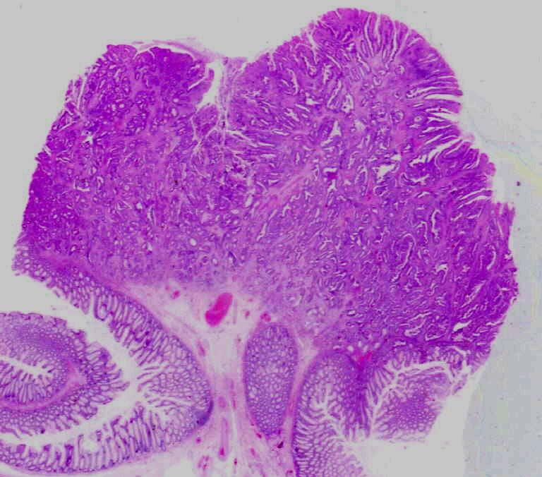 ADENOMI CANCERIZZATI: INFILTRAZIONE NEOPLASTICA DELLA SOTTOMUCOSA ATTRAVERSO IL SUPERAMENTO DELLA