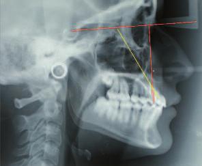 difficoltà nel raggiungimento di un corretto overjet ed overbite e di un buon rapporto interarcata oltre