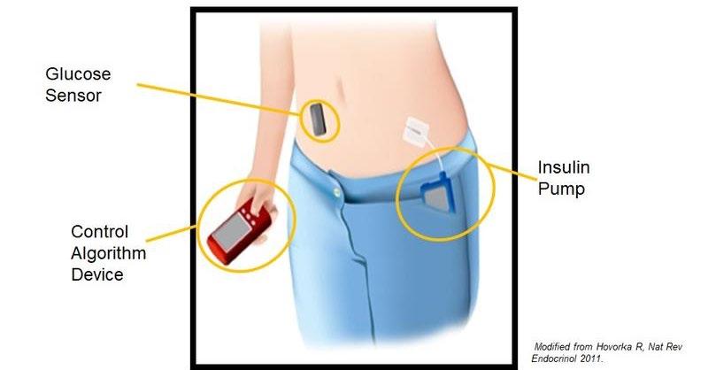 Il pancreas artificiale (closed loop) Algoritmo di