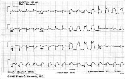 STEMI