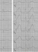 occlusione molto prossimale si associa ad estensione laterale coinvolgendo