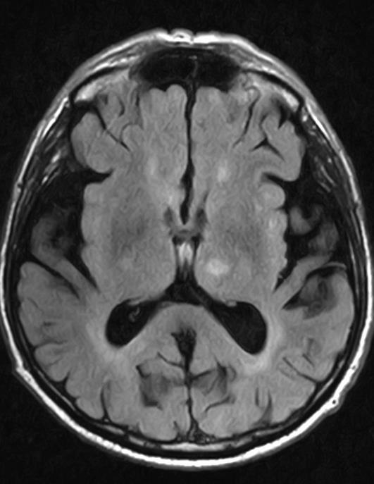 FLAIR DWI RM ENCEFALO Iperintensita' della sostanza