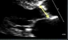 Echocardiogram annulus assessment Measure: In Systole