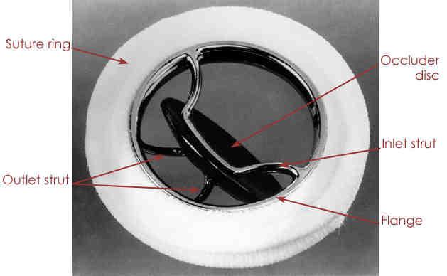 Monoleaflet (Tilting disc) Disegno: Housing circondato da un anello ruotabile rivestito di tessuto in fibra sintetica e suddiviso in due orifizi, uno maggiore ed uno minore, da un disco oscillante.