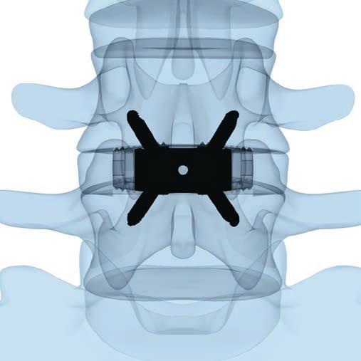 8. Verifica del posizionamento L impianto SynFix-LR è posizionato in modo ottimale quando si trova completamente all interno dei confini dei corpi vertebrali.