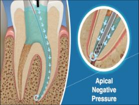 illuminazione in Endodonzia Caratteristiche del movimento