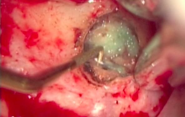 Endodonzia chirurgica: indicazioni e controindicazioni L importanza del