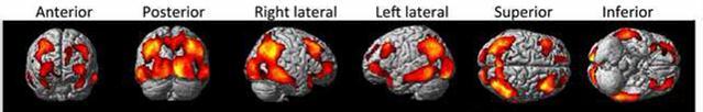 PET-FDG in PD-MCI, PDnonMCI e PDD PDD Vs NV PD- MCI Vs NV Normalizzazi one: ponte PDD (n=19), PD-MCI