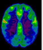 PET-18FDG/SPECT CBF nel PD e PDD Alterazioni metaboliche sono presenti nei PD dalle fasi precoci della malattia