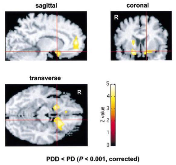 Disfunzione DA corticale nel PDD: PET-18F-DOPA Correlazione