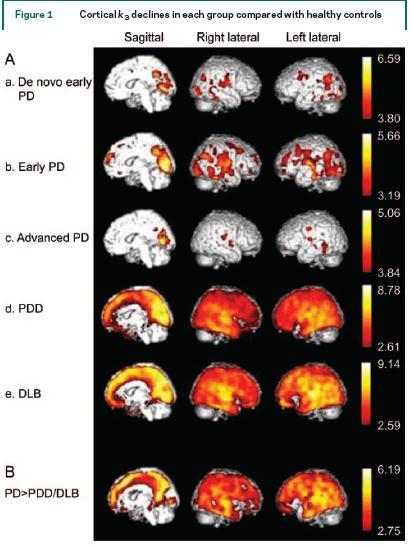 Sistema colinergico alterato dalle fasi precoci della malattia riduzione nella corteccia occipitale mediale nelle fasi più precoci Maggiore e più diffusa riduzione corticale nel PDD (corteccia